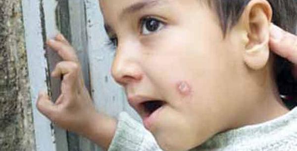 عکس نیش پشه سالک
