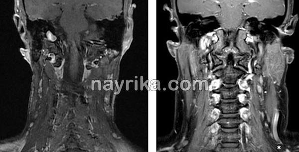 عکس ام آر آی دیسک گردن
