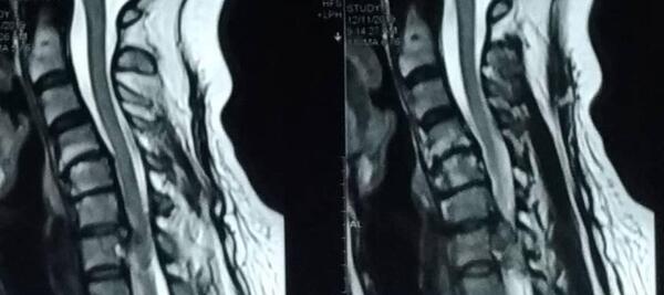 عکس ام آر آی دیسک گردن