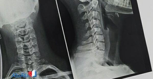 عکس ام آر آی دیسک گردن