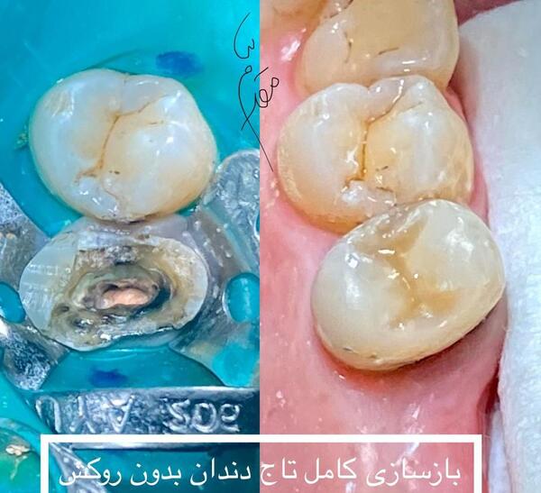 عکس تاج دندان