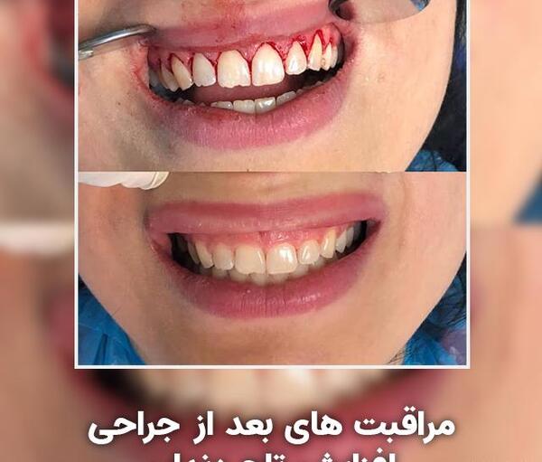 عکس تاج دندان