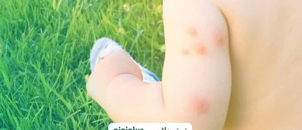 عکس نیش پشه
