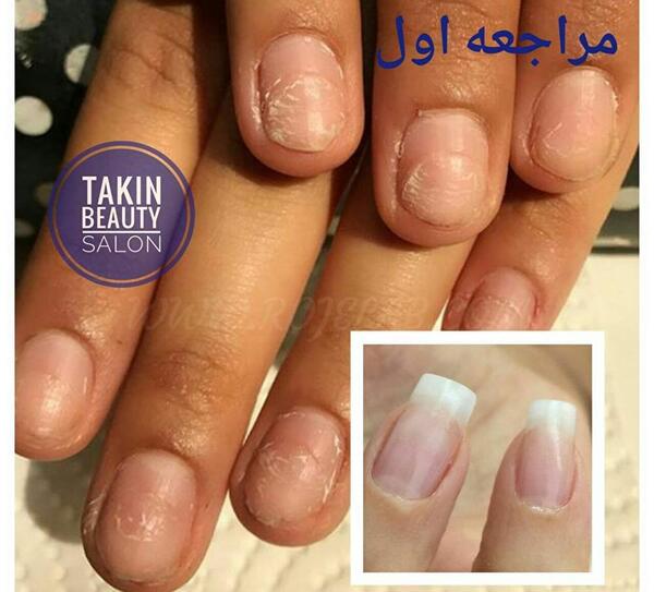 عکس ترمیم کاشت ناخن