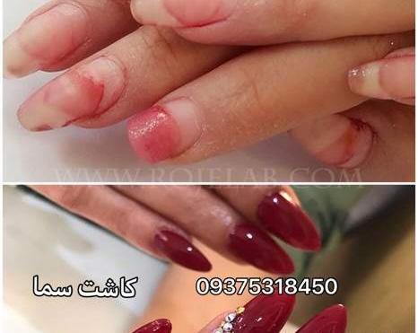 عکس ترمیم کاشت ناخن