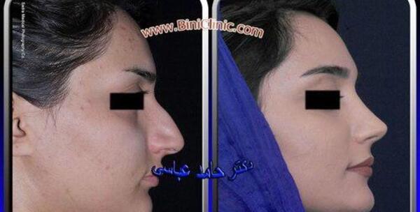 عکس مدل های عمل بینی