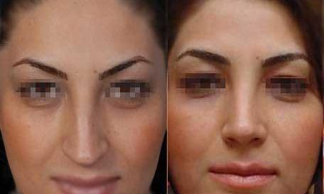 عکس مدل های عمل بینی