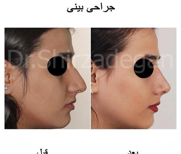 عکس مدل های عمل بینی
