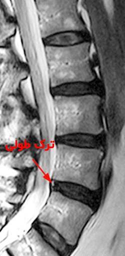 تفسیر عکس ام ار ای ستون فقرات