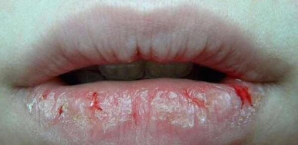 عکس لب ترک خورده