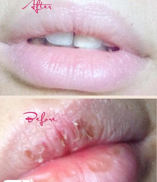 عکس لب ترک خورده