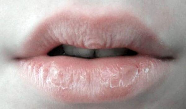 عکس لب ترک خورده