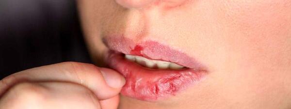 عکس لب ترک خورده