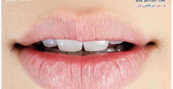 عکس لب ترک خورده