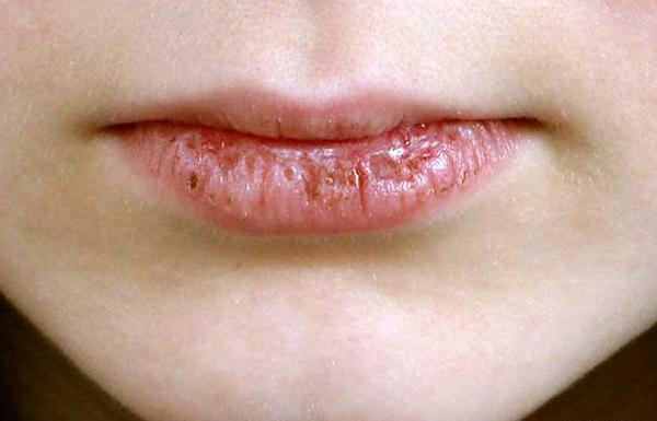 عکس لب ترک خورده