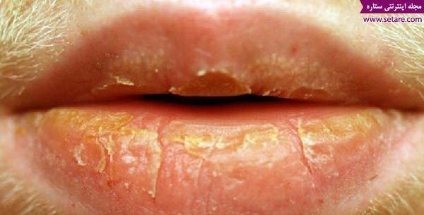عکس لب ترک خورده