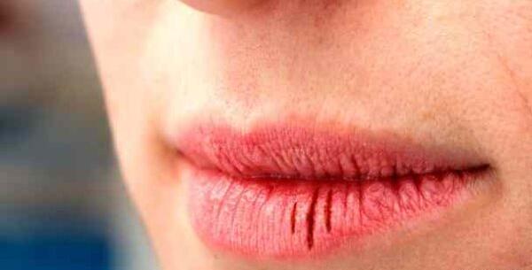 عکس لب ترک خورده