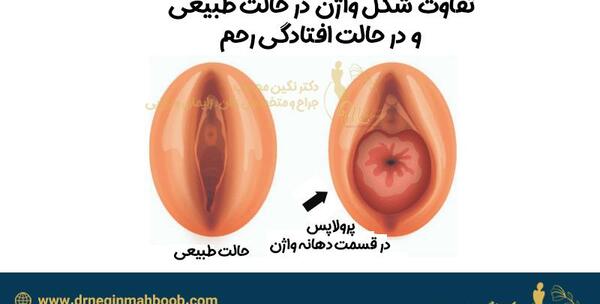 عکس واقعی بیرون زدگی رحم
