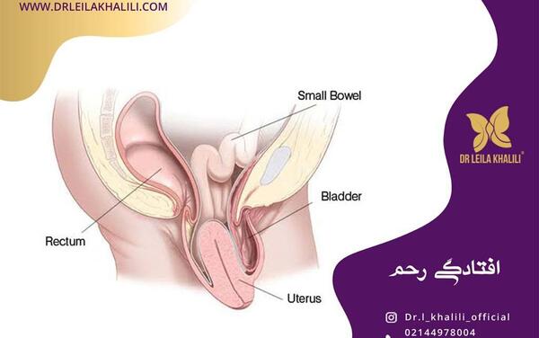عکس واقعی بیرون زدگی رحم