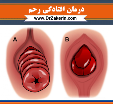 عکس واقعی بیرون زدگی رحم