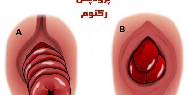 عکس واقعی بیرون زدگی رحم