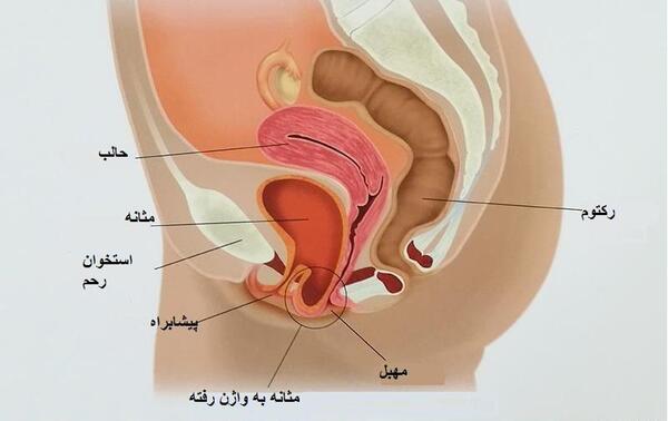 عکس واقعی بیرون زدگی رحم