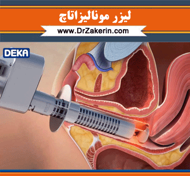عکس واقعی بیرون زدگی رحم