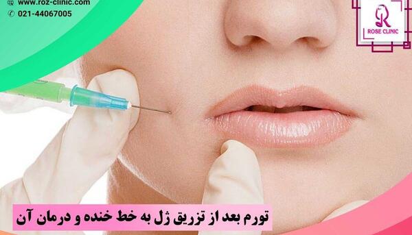 عکس لب در حال خنده