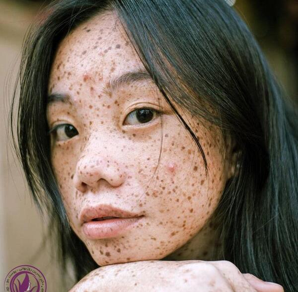 عکس صورت خال خالی