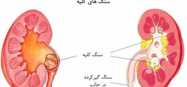 عکس سنگ کلیه انسان
