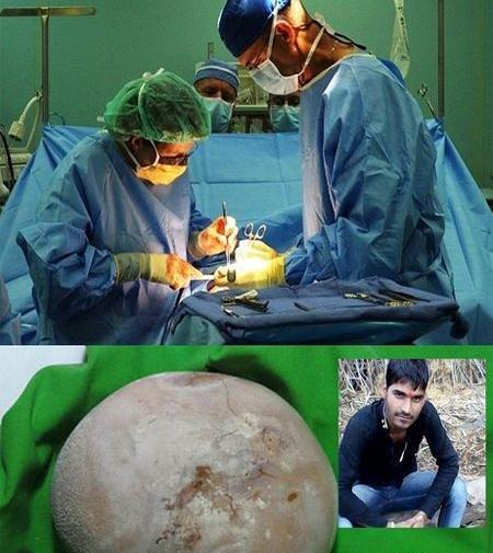 عکس سنگ کلیه انسان