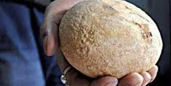 عکس سنگ کلیه انسان