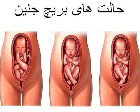 عکس جنین نشسته