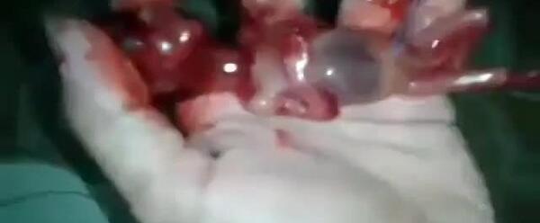 عکس جنین سقط شده دختر