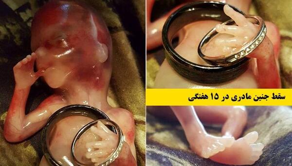 عکس جنین سقط شده دختر