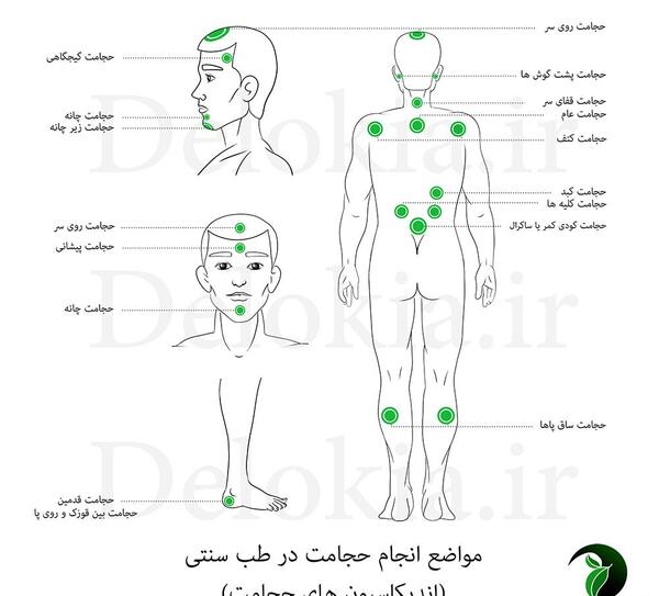 عکس و تصویر نقاط حجامت