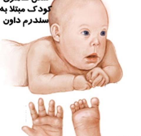 عکس نوزاد سندرومی
