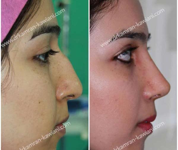 عکس مدل های دماغ عملی