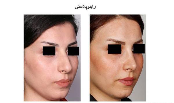 عکس مدل های دماغ عملی