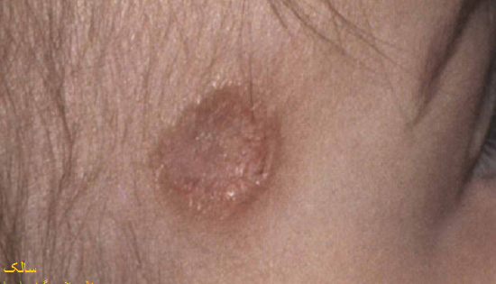 عکس و تصویر گزیدگی سالک