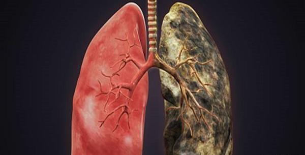 عکس ریه یک فرد سیگاری