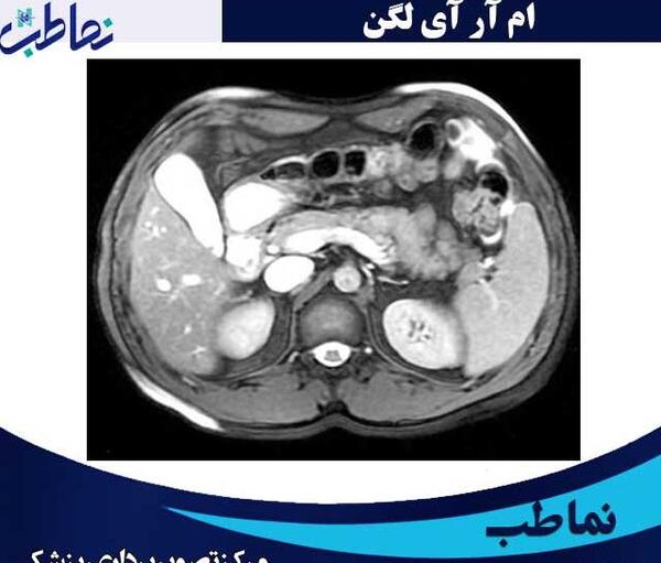 عکس ام ار ای شکم