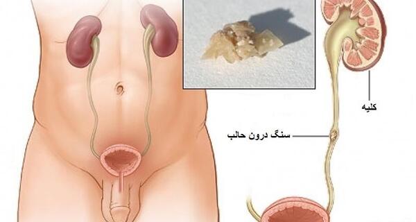 عکس سنگ در کلیه