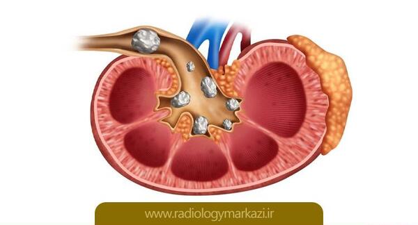 عکس سنگ در کلیه