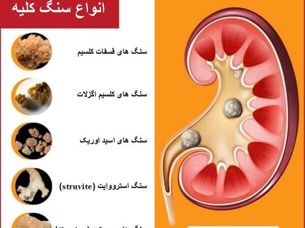 عکس سنگ در کلیه