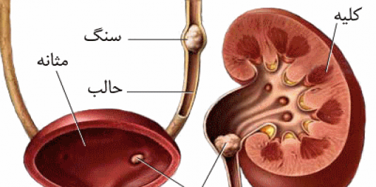 عکس سنگ در کلیه