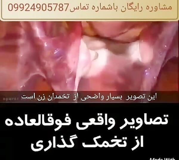 عکس و تصویر تخمک آزاد شده در سونوگرافی