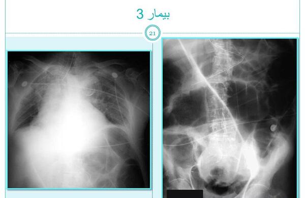 عکس ایستاده شکم