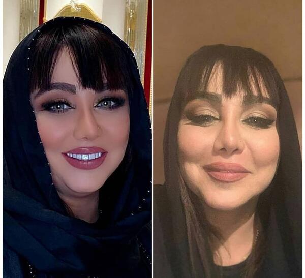 عکس بهنوش بختیاری بعد از عمل