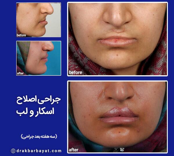 عکس لب شکری بعد از عمل